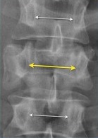 interpedicular distance