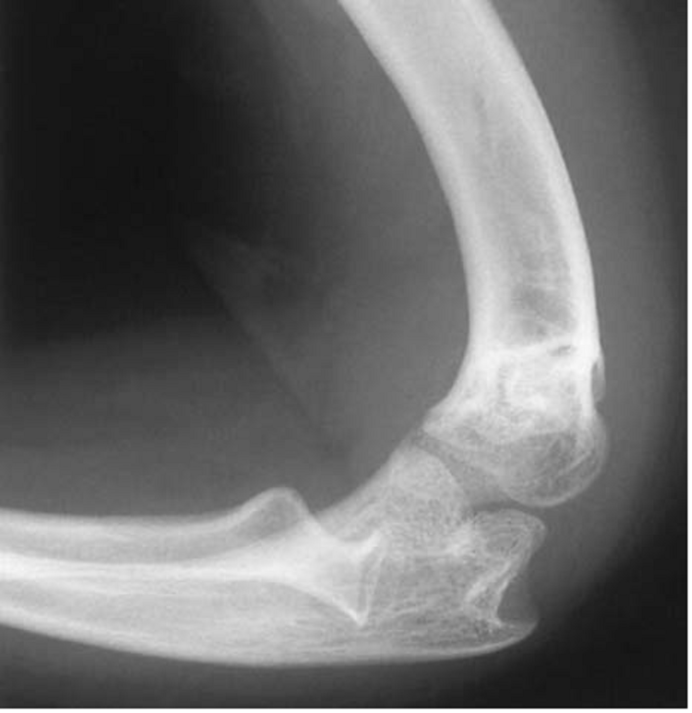Deformities of the elbow in achondroplasia at http://www.boneandjoint.org.uk/