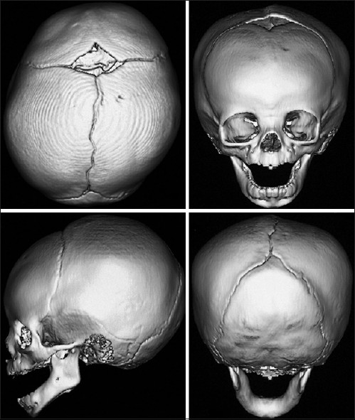 Craniosynostosis, Ramesh Kumar Sharma. Figure 1: The sutures in a normal infant http://www.ijps.org/viewimage.asp?img=ijps_2013_46_1_18_113702_f1.jpg