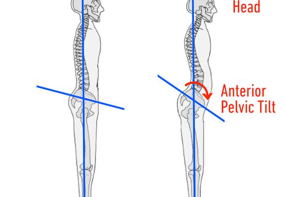 pelvic tilt