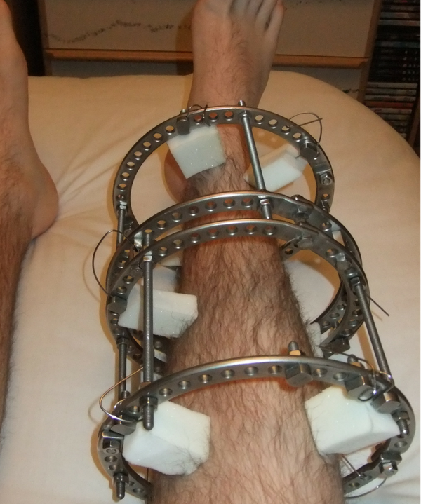 Ilizarov apparatus external fixator s