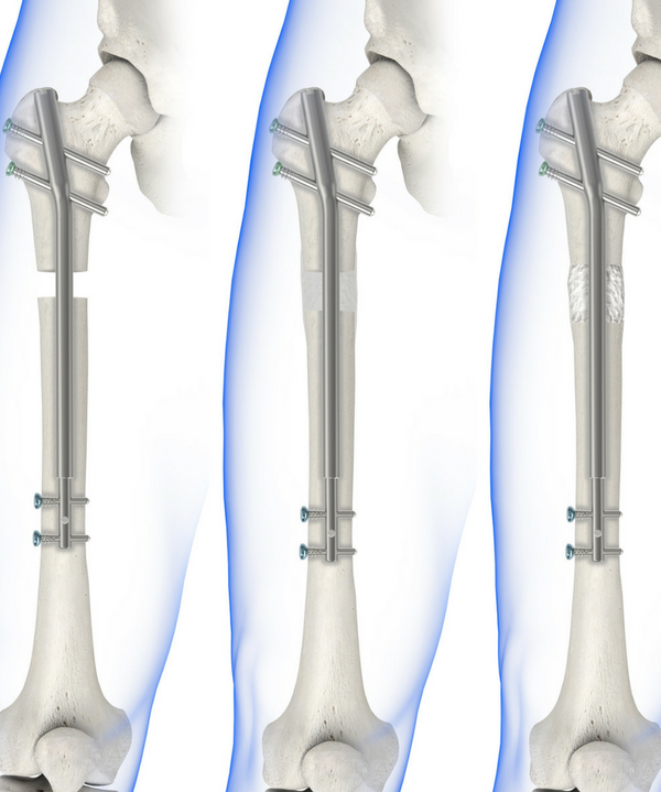 PRECICE internal fixator s