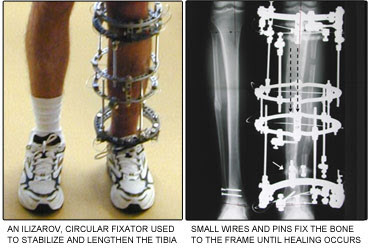 ilizarov external fixator